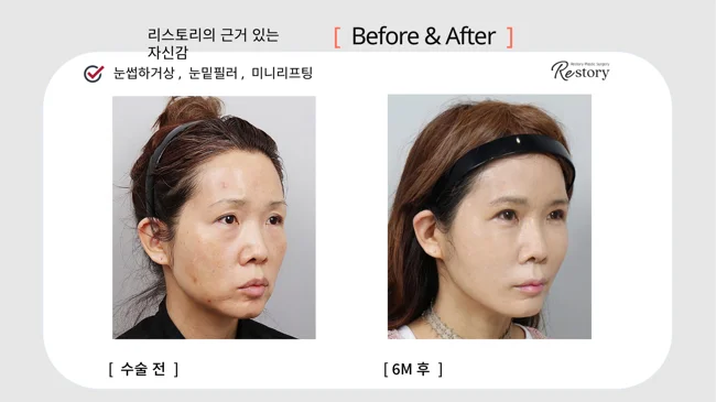 Sub-brow lift, under-eye filler and mini lifting · 006 at Restory Plastic Surgery Clinic. Angled view. Before on the left; after on the right. The photographs show the eyelid contours, brows and their relationship to the upper cheeks. The after photograph is labelled 6 months.