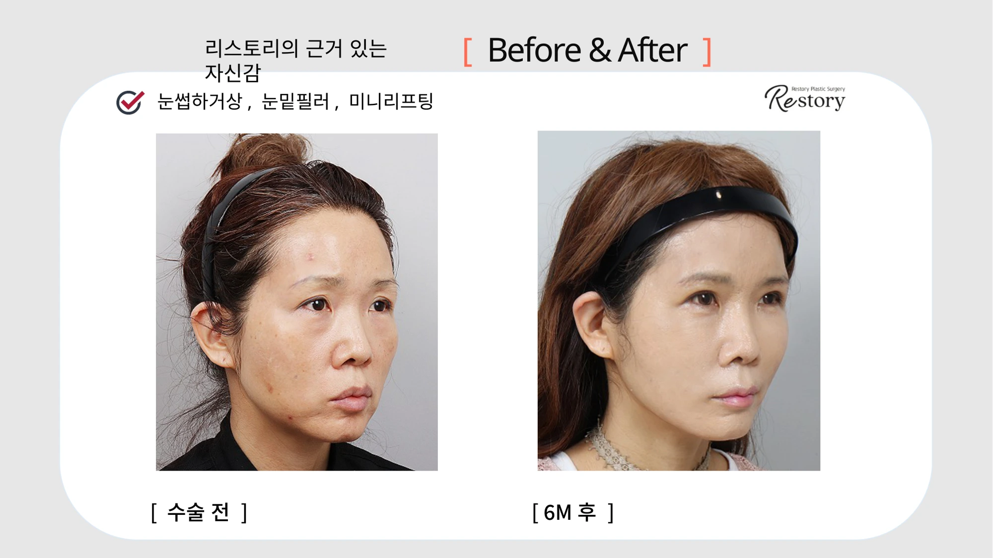 Sub-brow lift, under-eye filler and mini lifting · 006 at Restory Plastic Surgery Clinic. Angled view. Before on the left; after on the right. The photographs show the eyelid contours, brows and their relationship to the upper cheeks. The after photograph is labelled 6 months.