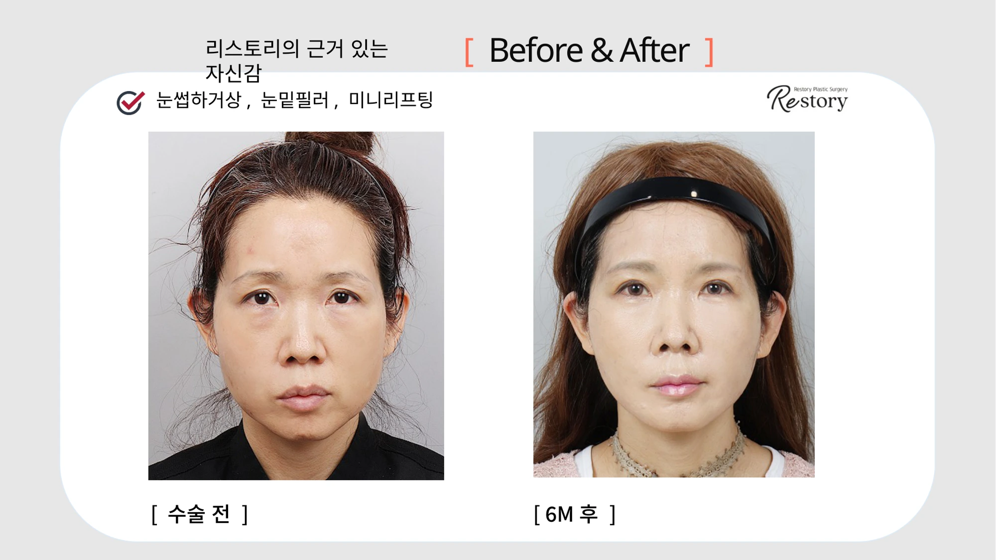 Sub-brow lift, under-eye filler and mini lifting · 006 at Restory Plastic Surgery Clinic. Front view. Before on the left; after on the right. The photographs show the eyelid contours, brows and their relationship to the upper cheeks. The after photograph is labelled 6 months.