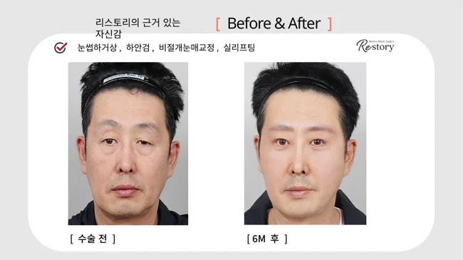 Sub-brow lift, lower blepharoplasty, ptosis correction and threads · 008 at Restory Plastic Surgery Clinic. Front view. Before on the left; after on the right. The photographs show the eyelid contours, brows and their relationship to the upper cheeks. The after photograph is labelled 6 months.