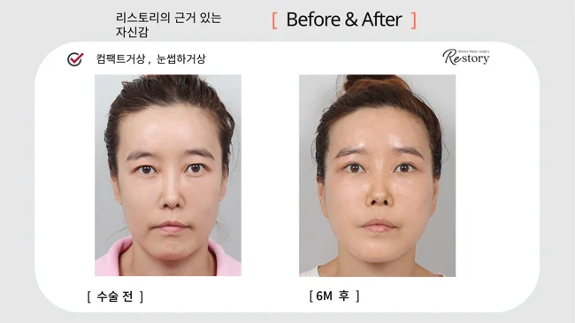 Compact facelift with sub-brow lift · 009 at Restory Plastic Surgery Clinic. Front view. Before on the left; after on the right. The photographs show the eyelid contours, brows and their relationship to the upper cheeks. The after photograph is labelled 6 months.