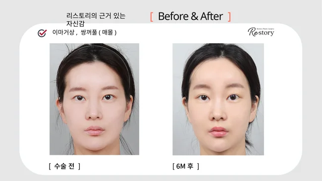 Forehead lift with buried-suture double-eyelid surgery · 011 at Restory Plastic Surgery Clinic. Front view. Before on the left; after on the right. The photographs show the eyelid contours, brows and their relationship to the upper cheeks. The after photograph is labelled 6 months.