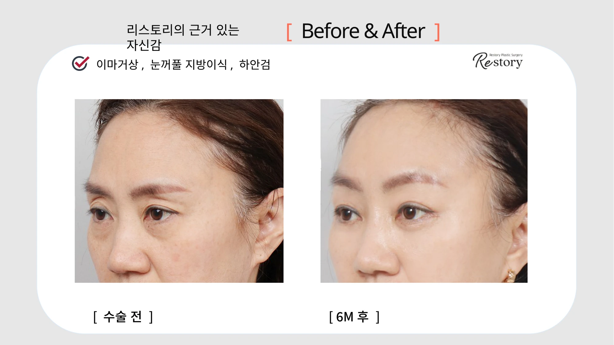 Forehead lift, eyelid fat grafting and lower blepharoplasty · 012 at Restory Plastic Surgery Clinic. Angled view. Before on the left; after on the right. The photographs show the eyelid contours, brows and their relationship to the upper cheeks. The after photograph is labelled 6 months.