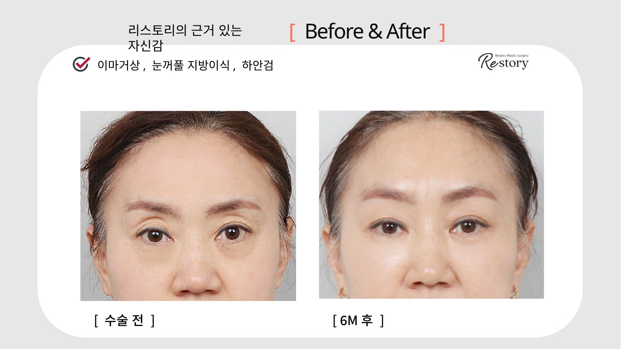 Forehead lift, eyelid fat grafting and lower blepharoplasty · 012 at Restory Plastic Surgery Clinic. Front view. Before on the left; after on the right. The photographs show the eyelid contours, brows and their relationship to the upper cheeks. The after photograph is labelled 6 months.