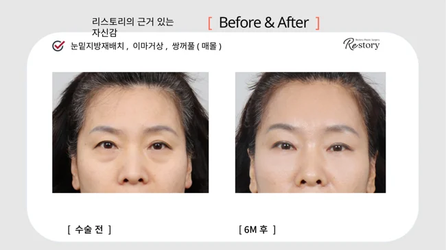 Under-eye fat repositioning, forehead lift and double eyelids · 014 at Restory Plastic Surgery Clinic. Front view. Before on the left; after on the right. The photographs show the eyelid contours, brows and their relationship to the upper cheeks. The after photograph is labelled 6 months.