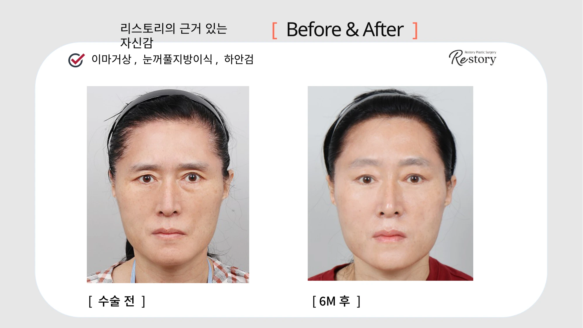 Forehead lift, eyelid fat grafting and lower blepharoplasty · 015 at Restory Plastic Surgery Clinic. Front view. Before on the left; after on the right. The photographs show the eyelid contours, brows and their relationship to the upper cheeks. The after photograph is labelled 6 months.