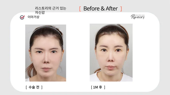 Forehead lift: front and angled views · 016 at Restory Plastic Surgery Clinic. Front view. Before on the left; after on the right. The photographs show the forehead, brow position and upper facial proportions. The after photograph is labelled 1 month.