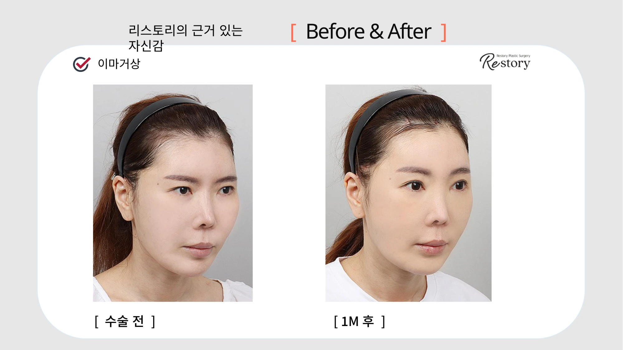 Forehead lift: front and angled views · 016 at Restory Plastic Surgery Clinic. Angled view. Before on the left; after on the right. The photographs show the forehead, brow position and upper facial proportions. The after photograph is labelled 1 month.