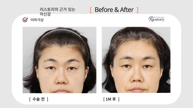 Forehead lift: upper-face follow-up · 018 at Restory Plastic Surgery Clinic. Front view. Before on the left; after on the right. The photographs show the forehead, brow position and upper facial proportions. The after photograph is labelled 1 month.