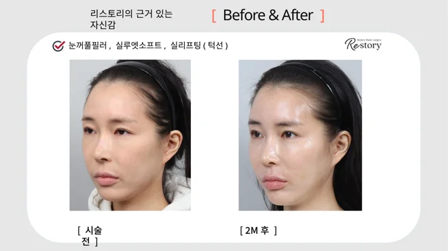 Eyelid filler, Silhouette Soft and jawline threads · 021 at Restory Plastic Surgery Clinic. Angled view. Before on the left; after on the right. The photographs show the cheek contours, folds beside the mouth and the jaw or neck outline. The after photograph is labelled 2 months.