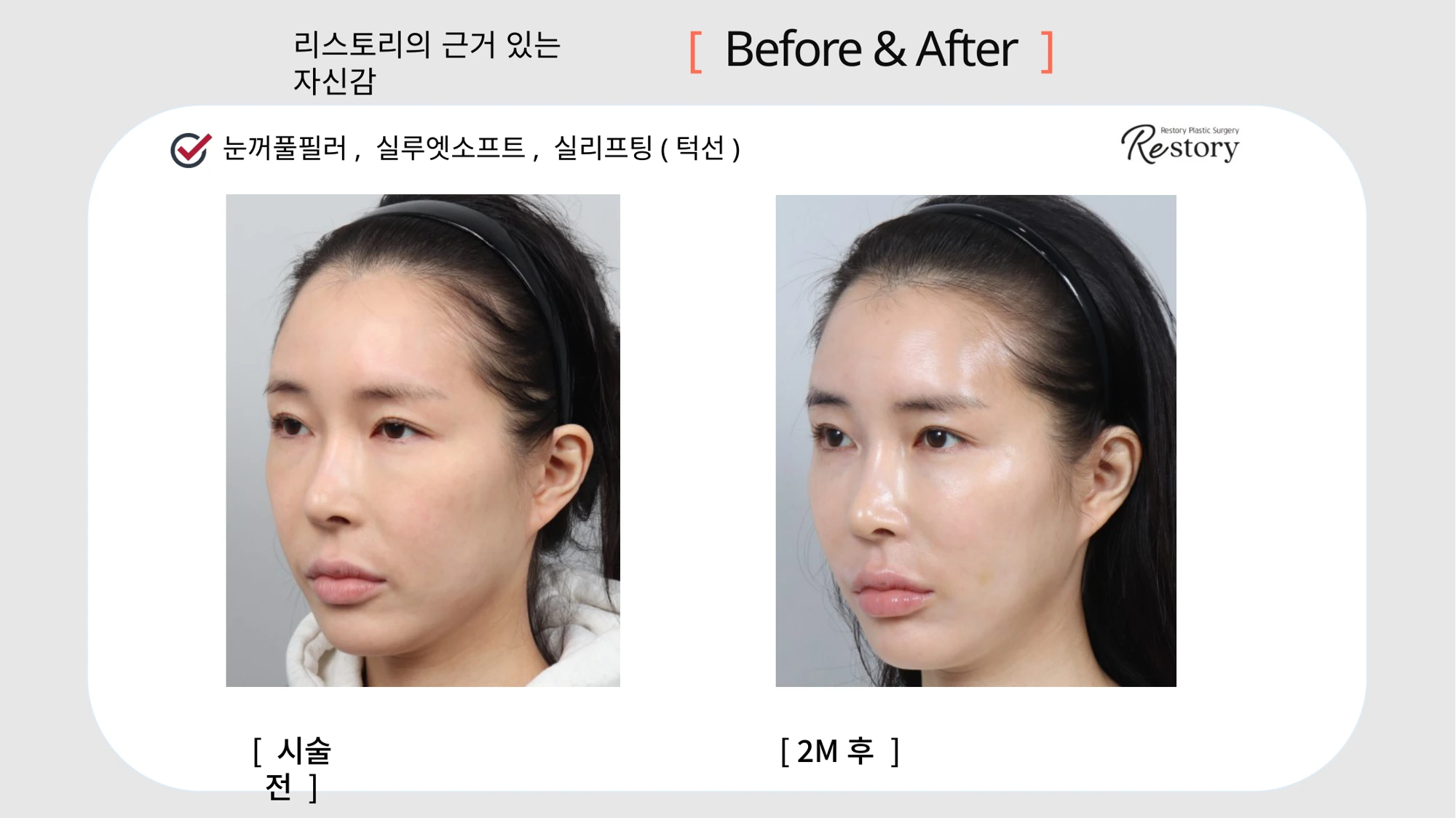 Eyelid filler, Silhouette Soft and jawline threads · 021 at Restory Plastic Surgery Clinic. Angled view. Before on the left; after on the right. The photographs show the cheek contours, folds beside the mouth and the jaw or neck outline. The after photograph is labelled 2 months.