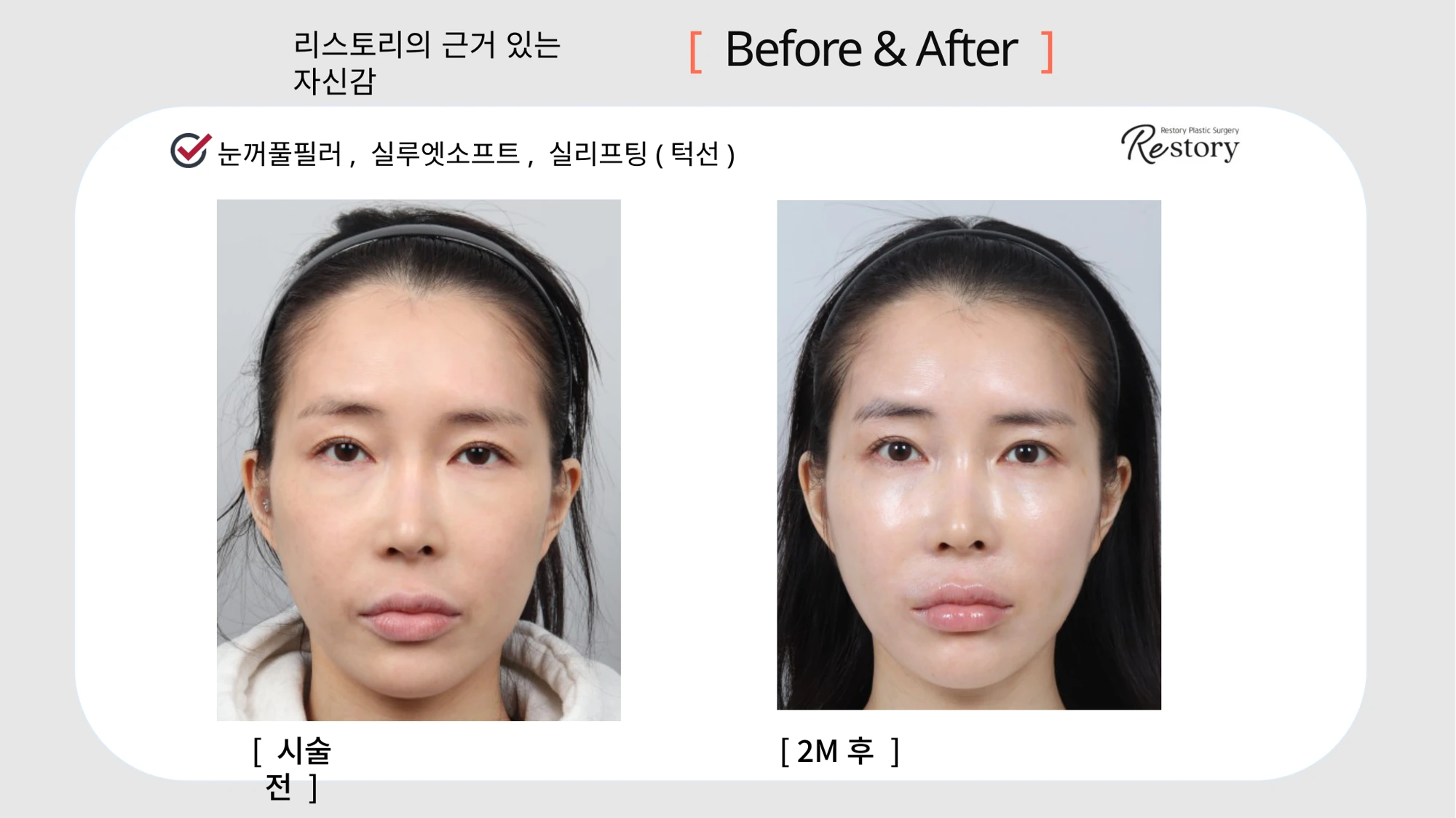 Eyelid filler, Silhouette Soft and jawline threads · 021 at Restory Plastic Surgery Clinic. Front view. Before on the left; after on the right. The photographs show the cheek contours, folds beside the mouth and the jaw or neck outline. The after photograph is labelled 2 months.