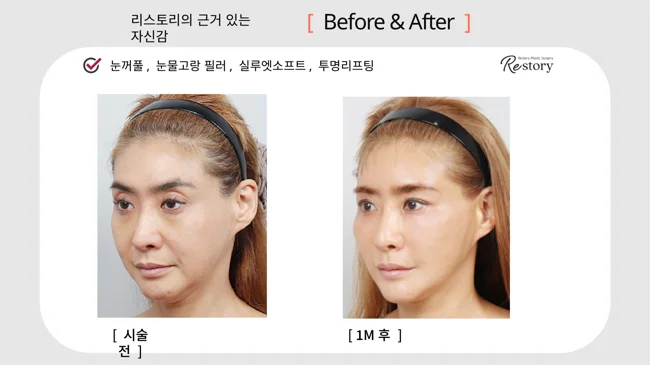 Eyelid and tear-trough fillers with Silhouette Soft lifting · 023 at Restory Plastic Surgery Clinic. Angled view. Before on the left; after on the right. The photographs show the cheek contours, folds beside the mouth and the jaw or neck outline. The after photograph is labelled 1 month.