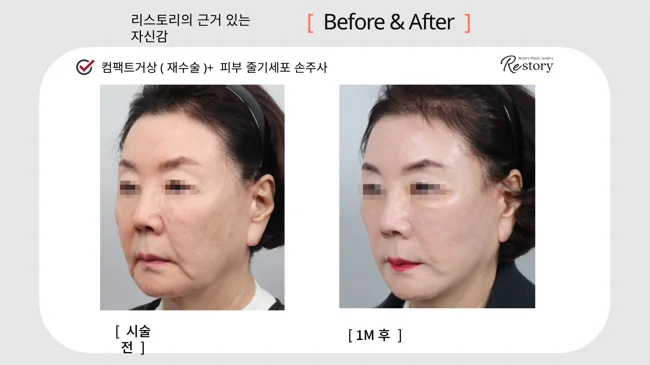Revision Compact facelift with stem-cell skin injections · 025 at Restory Plastic Surgery Clinic. Angled view. Before on the left; after on the right. The photographs show the cheek contours, folds beside the mouth and the jaw or neck outline. The after photograph is labelled 1 month.