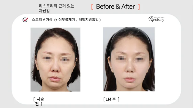 Story V lift with buccal fat removal and chin liposuction · 027 at Restory Plastic Surgery Clinic. Front view. Before on the left; after on the right. The photographs show the cheek contours, folds beside the mouth and the jaw or neck outline. The after photograph is labelled 1 month.