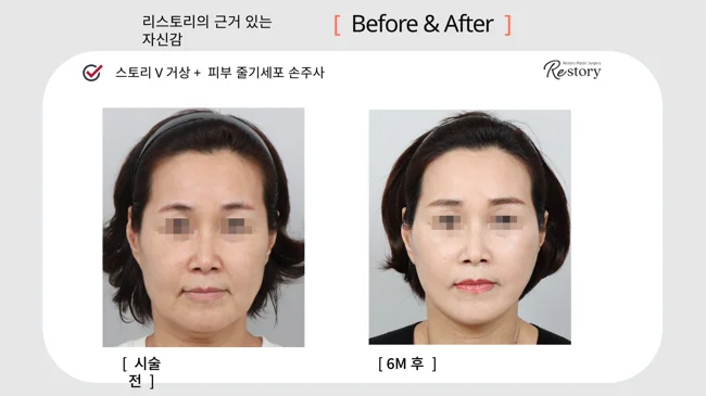 Story V lift with stem-cell skin injections · 029 at Restory Plastic Surgery Clinic. Front view. Before on the left; after on the right. The photographs show the cheek contours, folds beside the mouth and the jaw or neck outline. The after photograph is labelled 6 months.