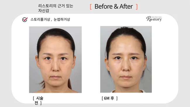 Story Full facelift with sub-brow lift · 031 at Restory Plastic Surgery Clinic. Front view. Before on the left; after on the right. The photographs show the cheek contours, folds beside the mouth and the jaw or neck outline. The after photograph is labelled 6 months.