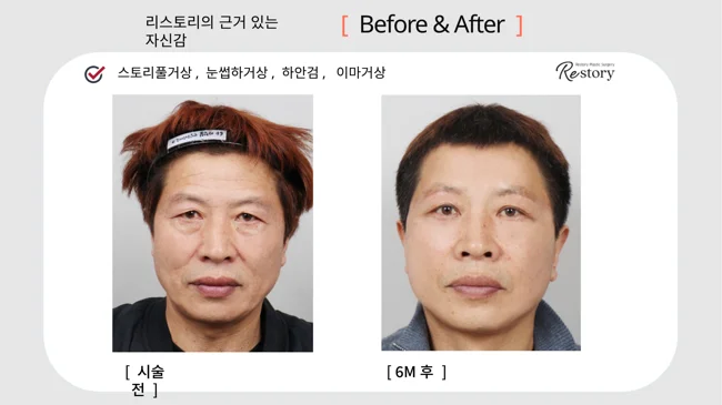 Story Full facelift, sub-brow lift and eyelid surgery · 033 at Restory Plastic Surgery Clinic. Front view. Before on the left; after on the right. The photographs show the cheek contours, folds beside the mouth and the jaw or neck outline. The after photograph is labelled 6 months.