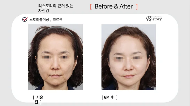 Story Full facelift with Corset lifting · 035 at Restory Plastic Surgery Clinic. Front view. Before on the left; after on the right. The photographs show the cheek contours, folds beside the mouth and the jaw or neck outline. The after photograph is labelled 6 months.