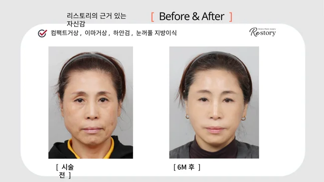 Compact facelift, forehead lift and eyelid procedures · 037 at Restory Plastic Surgery Clinic. Front view. Before on the left; after on the right. The photographs show the cheek contours, folds beside the mouth and the jaw or neck outline. The after photograph is labelled 6 months.