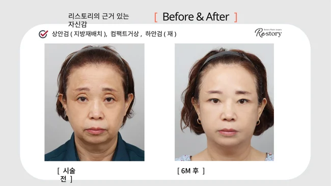 Upper eyelid fat repositioning, Compact lift and revision lower lids · 039 at Restory Plastic Surgery Clinic. Front view. Before on the left; after on the right. The photographs show the cheek contours, folds beside the mouth and the jaw or neck outline. The after photograph is labelled 6 months.