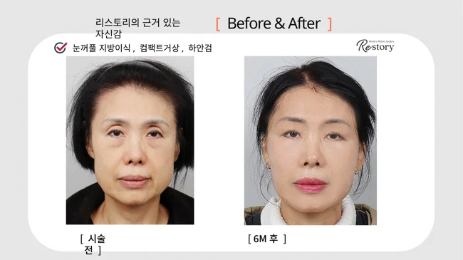 Eyelid fat grafting, Compact facelift and lower blepharoplasty · 041 at Restory Plastic Surgery Clinic. Front view. Before on the left; after on the right. The photographs show the cheek contours, folds beside the mouth and the jaw or neck outline. The after photograph is labelled 6 months.