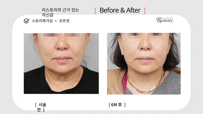 Story neck lift with Corset lifting · 043 at Restory Plastic Surgery Clinic. Front view. Before on the left; after on the right. The photographs show the cheek contours, folds beside the mouth and the jaw or neck outline. The after photograph is labelled 6 months.