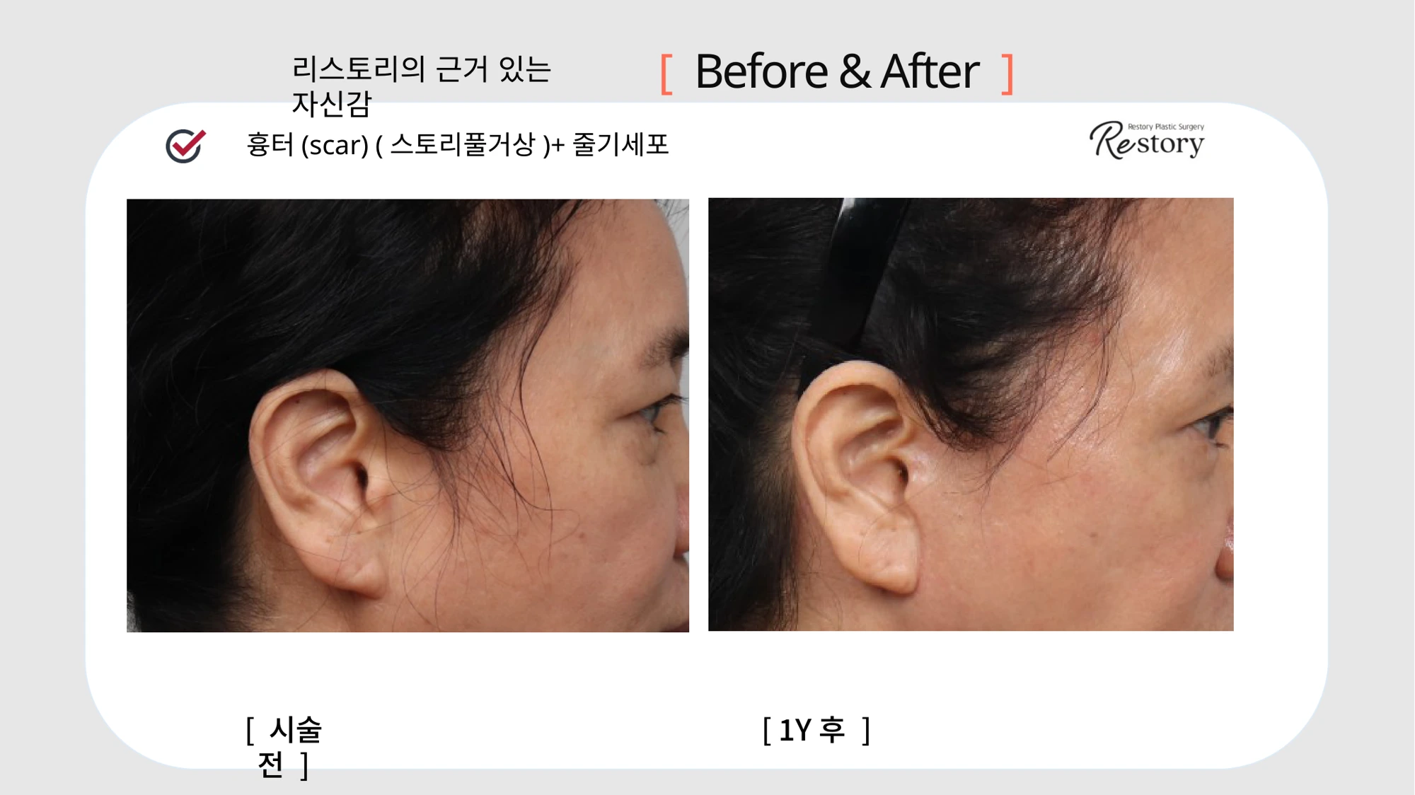 Facelift scar comparison with stem-cell treatment · 045 at Restory Plastic Surgery Clinic. Ear-area side view. Before on the left; after on the right. The photographs show the skin in front of the ear, scar line and earlobe attachment. The after photograph is labelled 1 year.
