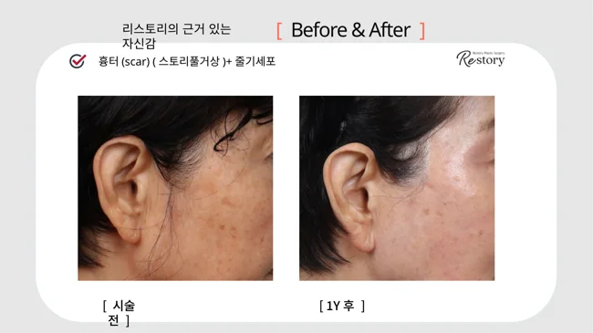 Facelift scar comparison with stem-cell treatment · 046 at Restory Plastic Surgery Clinic. Ear-area side view. Before on the left; after on the right. The photographs show the skin in front of the ear, scar line and earlobe attachment. The after photograph is labelled 1 year.