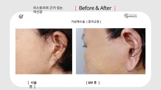 Revision facelift with earlobe correction · 047 at Restory Plastic Surgery Clinic. Ear close-up. Before on the left; after on the right. The photographs show the skin in front of the ear, scar line and earlobe attachment. The after photograph is labelled 6 months.