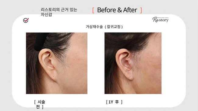 Revision facelift with earlobe correction · 048 at Restory Plastic Surgery Clinic. Ear close-up. Before on the left; after on the right. The photographs show the skin in front of the ear, scar line and earlobe attachment. The after photograph is labelled 1 year.