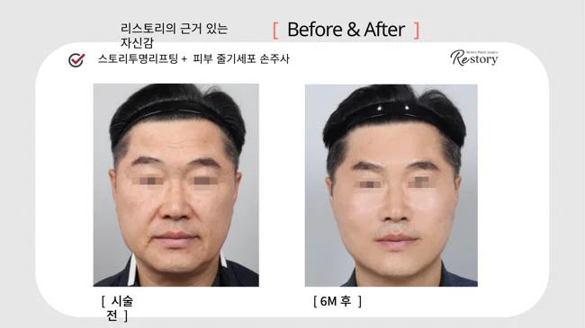Story Transparent lifting with stem-cell skin injections · 049 at Restory Plastic Surgery Clinic. Front view. Before on the left; after on the right. The photographs show the cheek contours, folds beside the mouth and the jaw or neck outline. The after photograph is labelled 6 months.