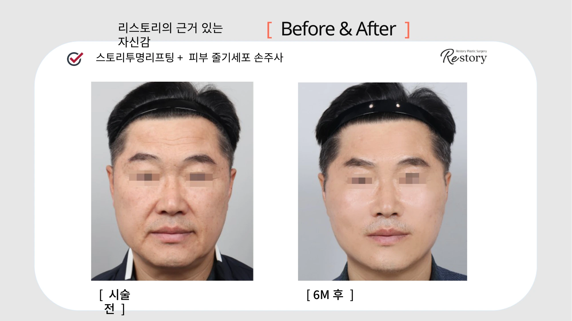 Story Transparent lifting with stem-cell skin injections · 049 at Restory Plastic Surgery Clinic. Front view. Before on the left; after on the right. The photographs show the cheek contours, folds beside the mouth and the jaw or neck outline. The after photograph is labelled 6 months.