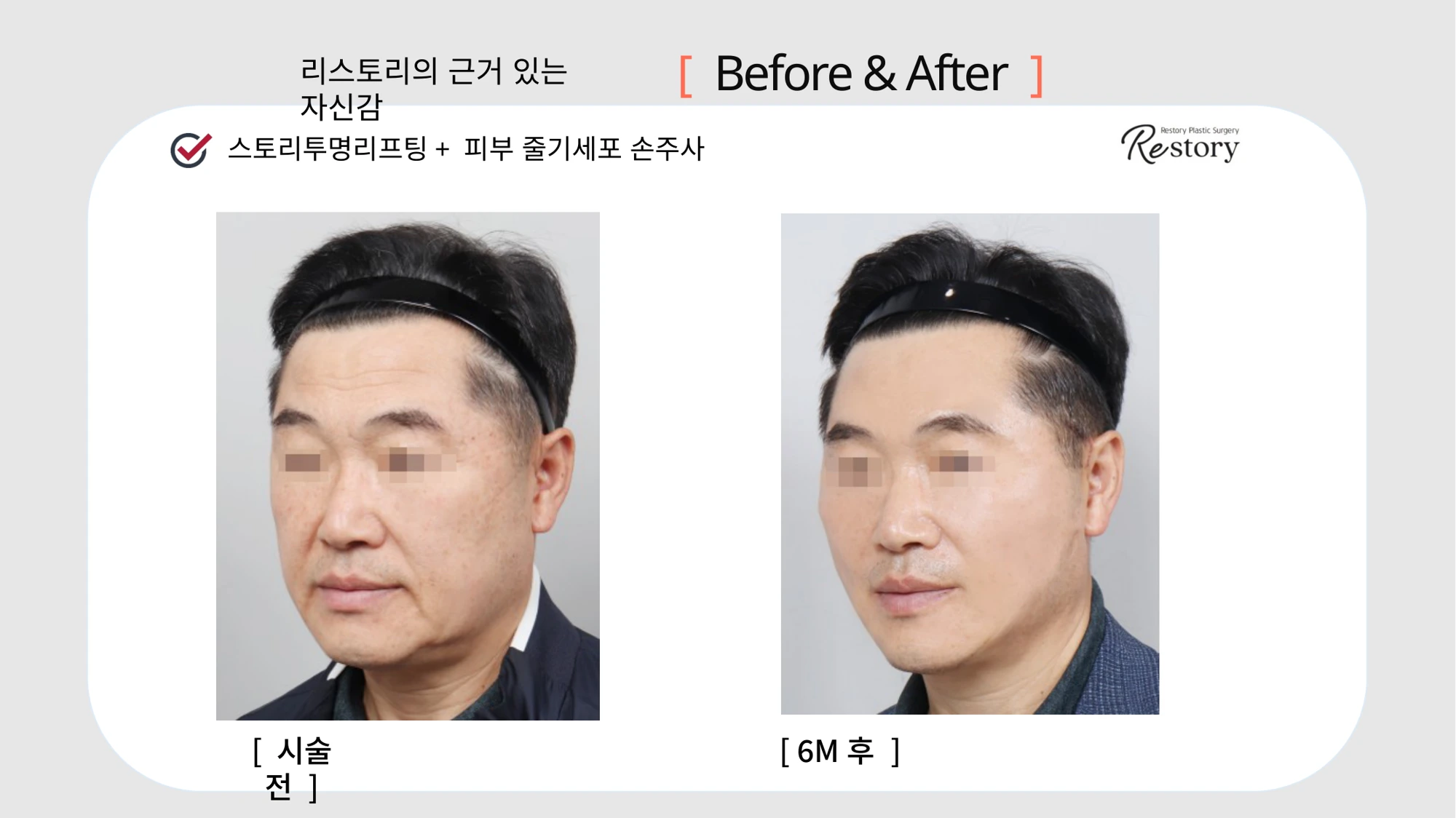 Story Transparent lifting with stem-cell skin injections · 049 at Restory Plastic Surgery Clinic. Angled view. Before on the left; after on the right. The photographs show the cheek contours, folds beside the mouth and the jaw or neck outline. The after photograph is labelled 6 months.