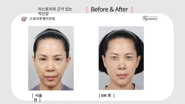 Story Transparent lifting · 051 at Restory Plastic Surgery Clinic. Front view. Before on the left; after on the right. The photographs show the cheek contours, folds beside the mouth and the jaw or neck outline. The after photograph is labelled 6 months.