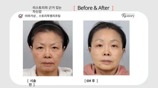 Forehead lift with Story Transparent lifting · 053 at Restory Plastic Surgery Clinic. Front view. Before on the left; after on the right. The photographs show the cheek contours, folds beside the mouth and the jaw or neck outline. The after photograph is labelled 6 months.