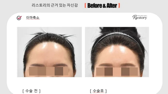 Forehead reduction: front and angled views · 055 at Restory Plastic Surgery Clinic. Front view. Before on the left; after on the right. The photographs show the forehead, brow position and upper facial proportions. The follow-up interval is not stated.