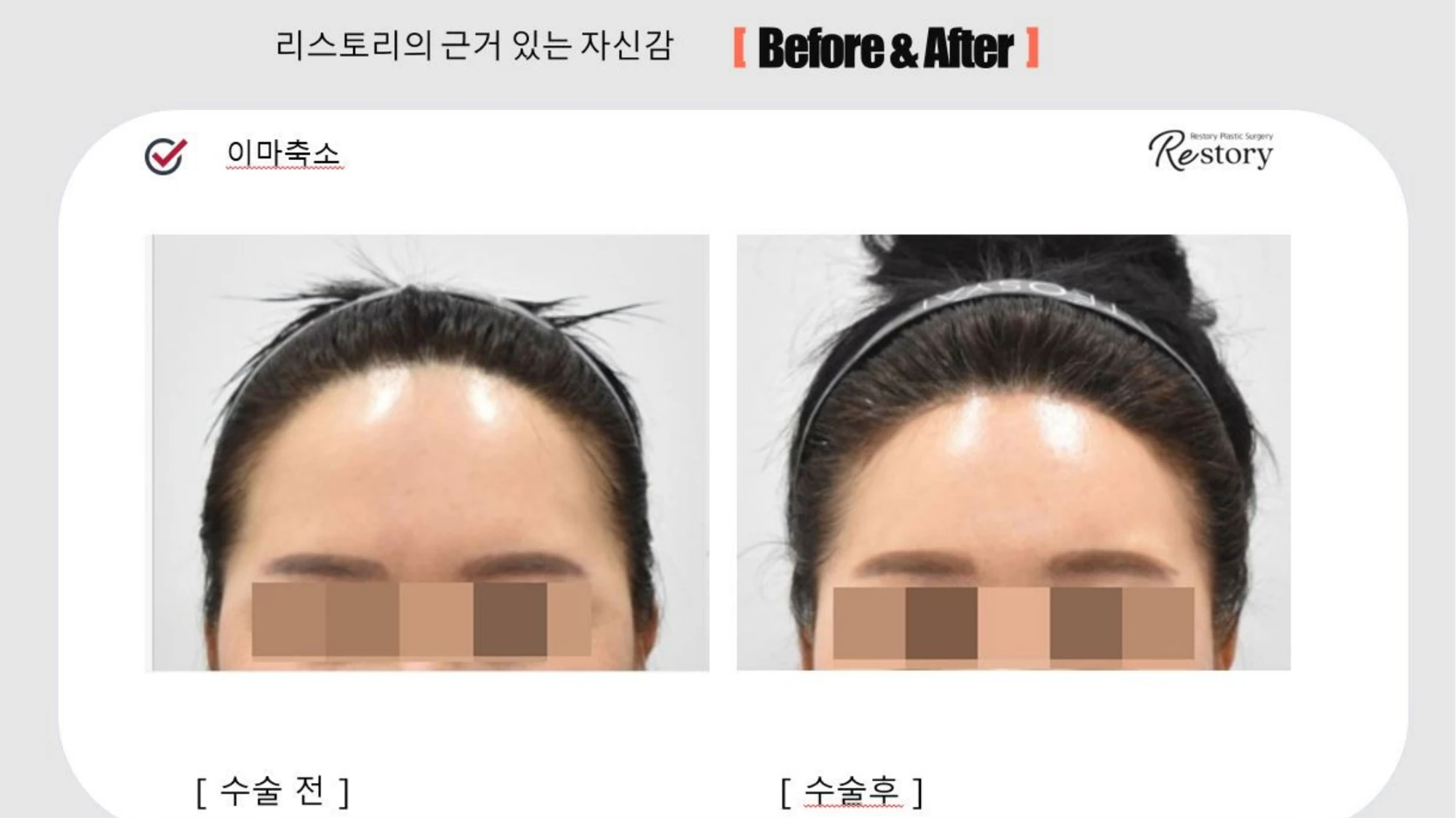 Forehead reduction: front and angled views · 055 at Restory Plastic Surgery Clinic. Front view. Before on the left; after on the right. The photographs show the forehead, brow position and upper facial proportions. The follow-up interval is not stated.