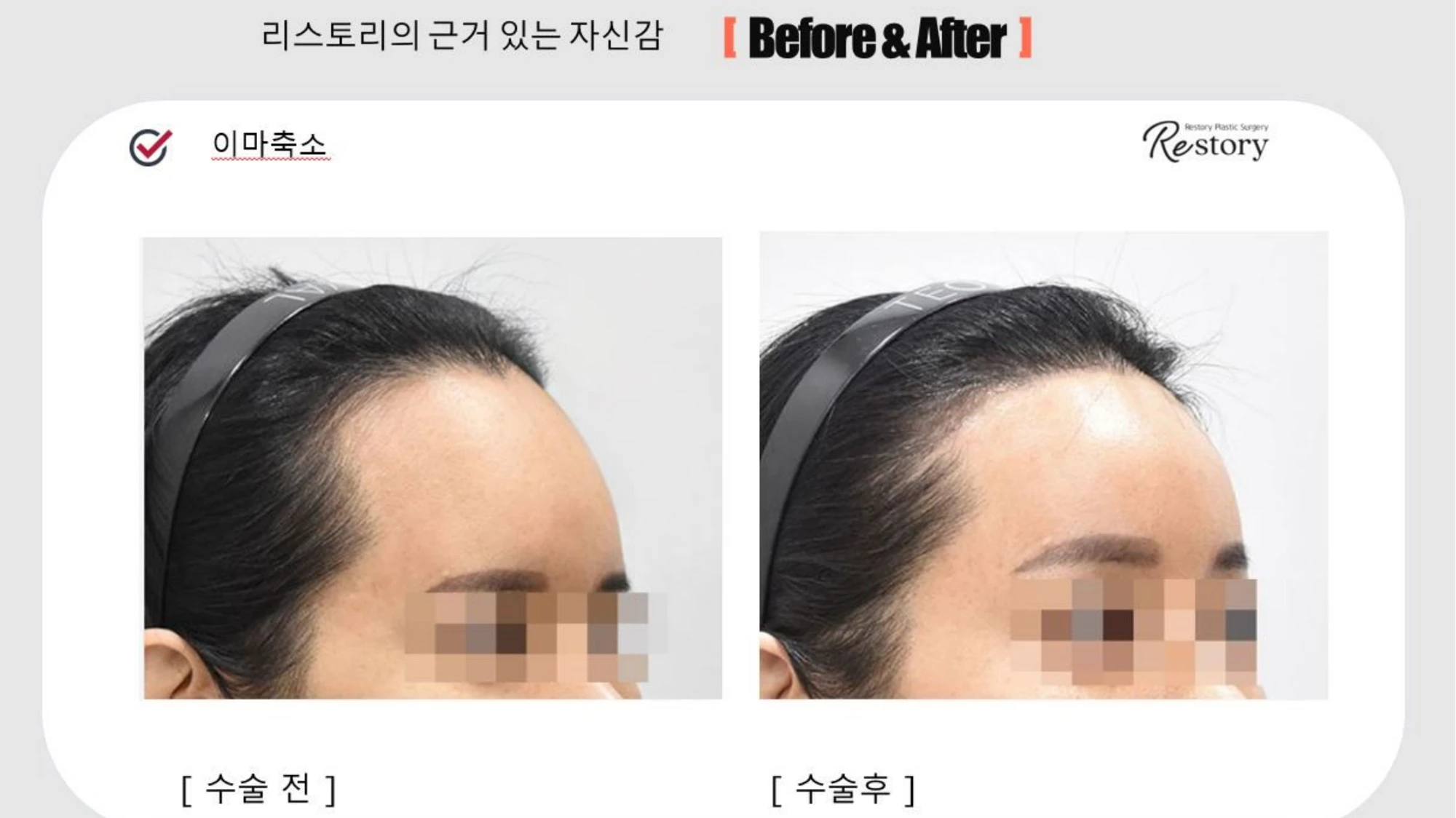 Forehead reduction: front and angled views · 055 at Restory Plastic Surgery Clinic. Angled view. Before on the left; after on the right. The photographs show the forehead, brow position and upper facial proportions. The follow-up interval is not stated.