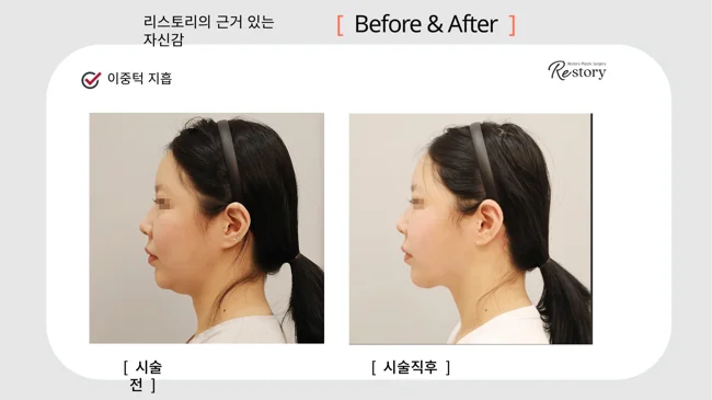 Under-chin liposuction · 058 at Restory Plastic Surgery Clinic. Side profile. Before on the left; after on the right. The photographs show the lower cheek or under-chin outline. The after photograph is labelled immediately after treatment.