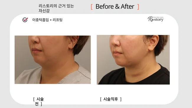 Under-chin liposuction with lifting · 059 at Restory Plastic Surgery Clinic. Angled lower-face view. Before on the left; after on the right. The photographs show the lower cheek or under-chin outline. The after photograph is labelled immediately after treatment.