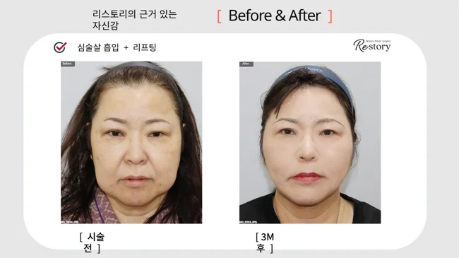 Jowl liposuction with lifting · 060 at Restory Plastic Surgery Clinic. Front view. Before on the left; after on the right. The photographs show the lower cheek or under-chin outline. The after photograph is labelled 3 months.