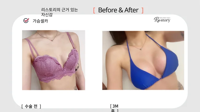 Breast surgery: patient photo comparison · 061 at Restory Plastic Surgery Clinic. Front view. Before on the left; after on the right. The photographs show the breast outline, position and upper fullness. The after photograph is labelled 3 months.