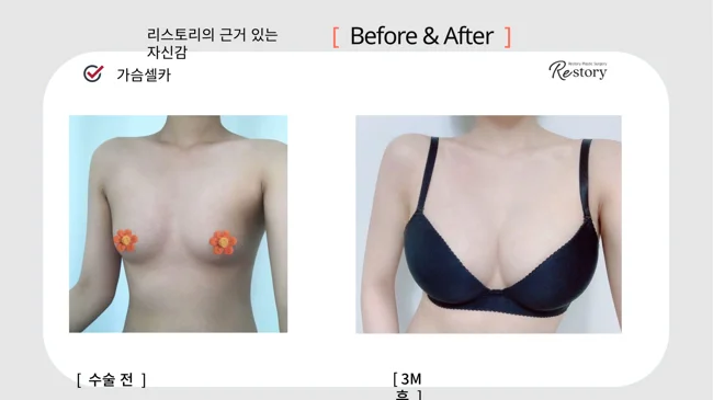 Breast surgery: patient photo comparison · 062 at Restory Plastic Surgery Clinic. Front view. Before on the left; after on the right. The photographs show the breast outline, position and upper fullness. The after photograph is labelled 3 months.