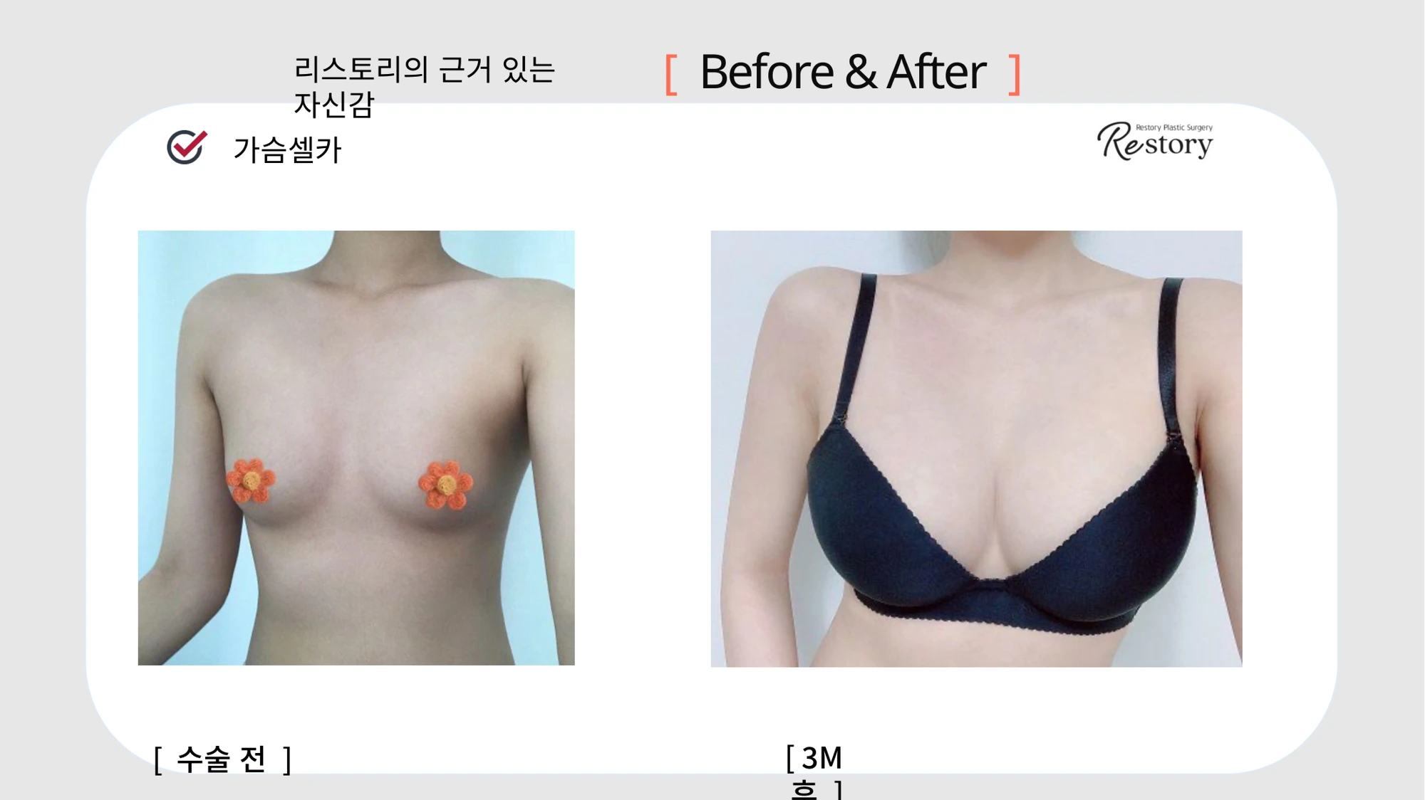 Breast surgery: patient photo comparison · 062 at Restory Plastic Surgery Clinic. Front view. Before on the left; after on the right. The photographs show the breast outline, position and upper fullness. The after photograph is labelled 3 months.