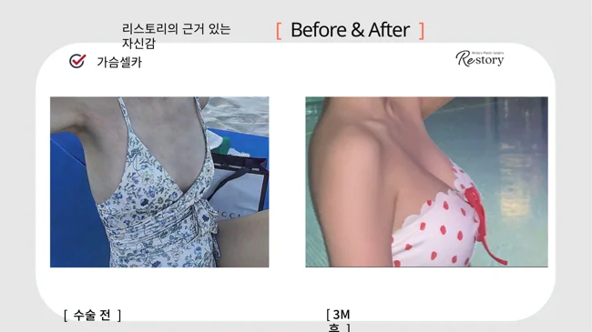 Breast surgery: patient photo comparison · 063 at Restory Plastic Surgery Clinic. Front view. Before on the left; after on the right. The photographs show the breast outline, position and upper fullness. The after photograph is labelled 3 months.