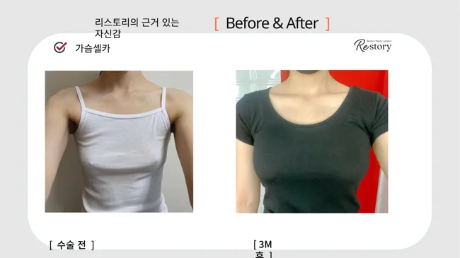 Breast surgery: patient photo comparison · 064 at Restory Plastic Surgery Clinic. Front view. Before on the left; after on the right. The photographs show the breast outline, position and upper fullness. The after photograph is labelled 3 months.