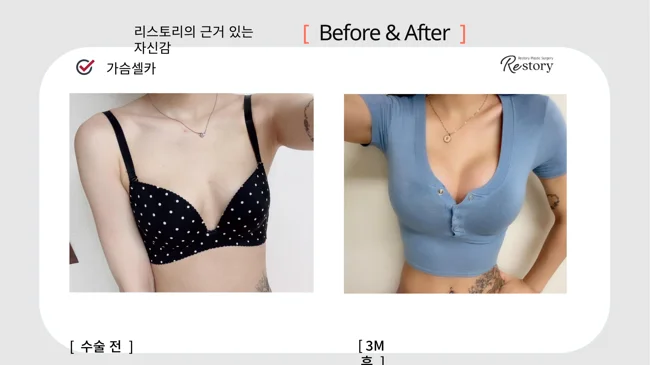 Breast surgery: patient photo comparison · 065 at Restory Plastic Surgery Clinic. Front view. Before on the left; after on the right. The photographs show the breast outline, position and upper fullness. The after photograph is labelled 3 months.