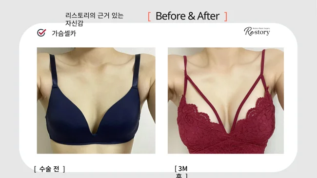 Breast surgery: patient photo comparison · 066 at Restory Plastic Surgery Clinic. Front view. Before on the left; after on the right. The photographs show the breast outline, position and upper fullness. The after photograph is labelled 3 months.