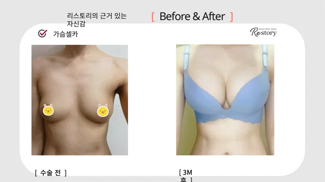 Breast surgery: patient photo comparison · 067 at Restory Plastic Surgery Clinic. Front view. Before on the left; after on the right. The photographs show the breast outline, position and upper fullness. The after photograph is labelled 3 months.